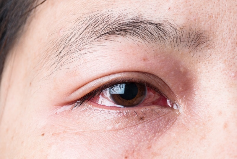 Bảo vệ mắt đúng cách trước dịch đau mắt đỏ